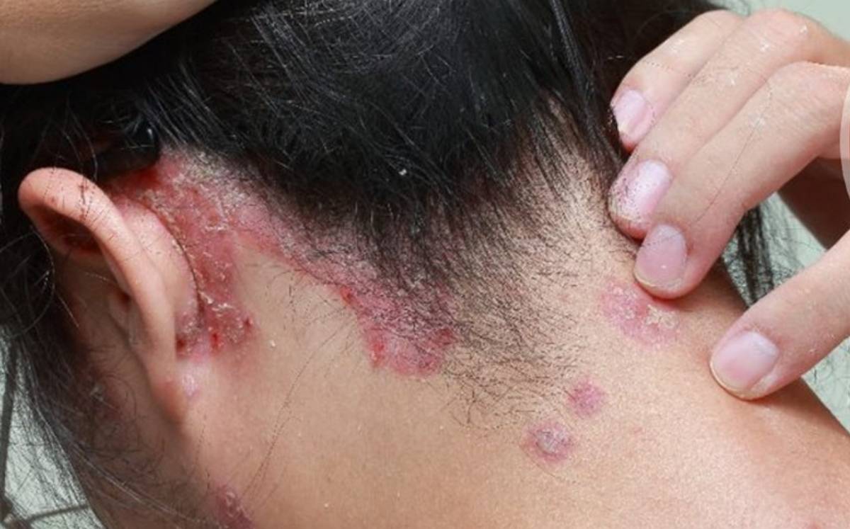 La Secretaría de Salud de Guanajuato atiende de manera oportuna los casos de lepra en la entidad.-